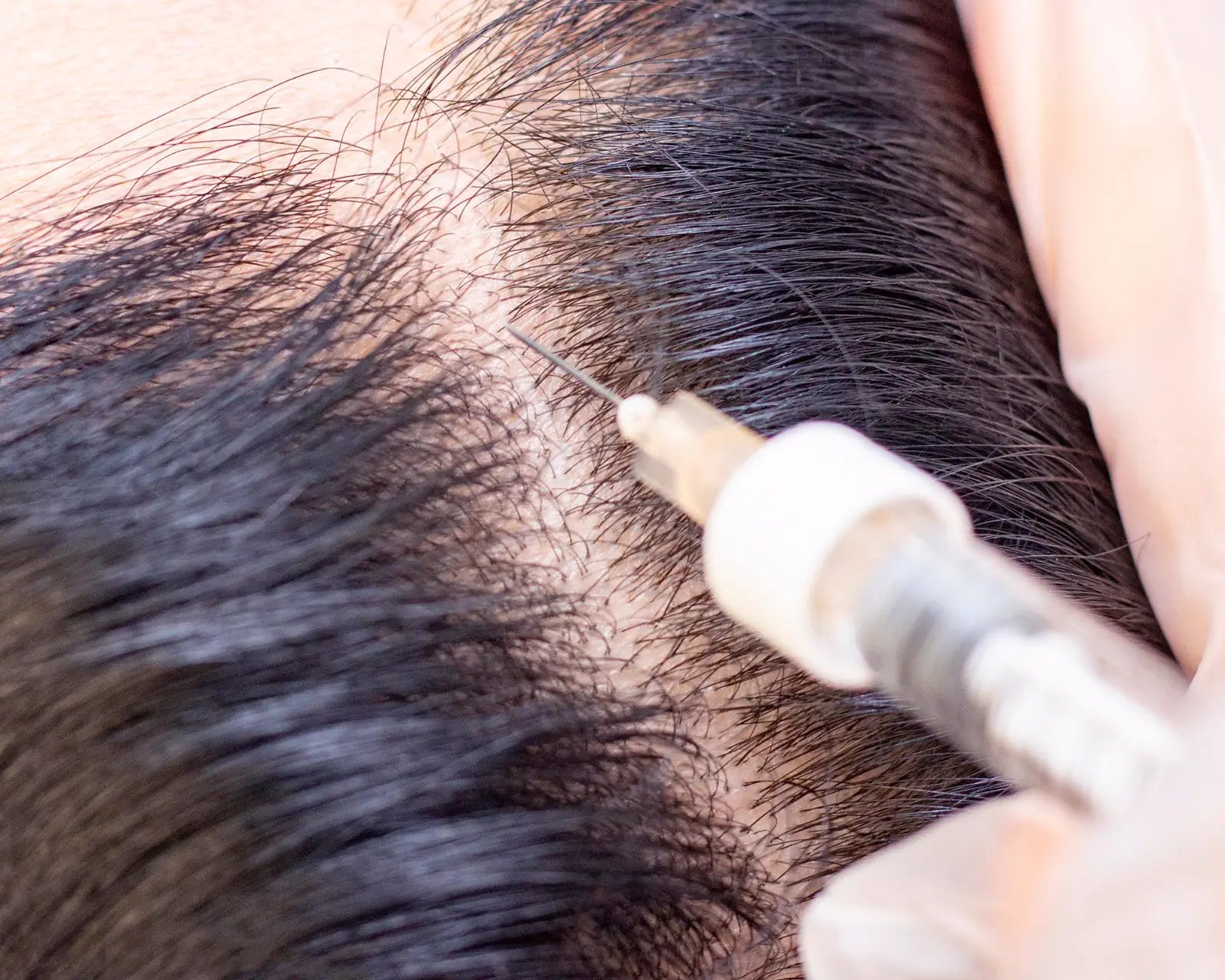 PRP injection into the scalp, close up