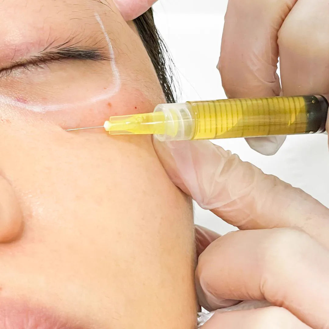 PRP injection under the eyes