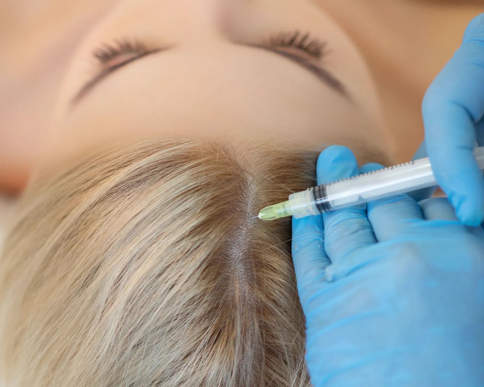 PRP injection into the centre of the scalp