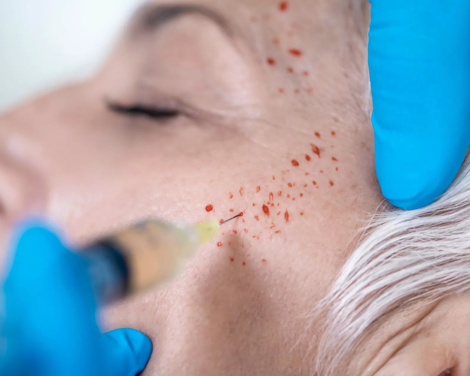 Practitioner performing PRP training for the face